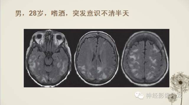 【病例】渗透性脱髓鞘综合征1例MR影像表现与鉴别