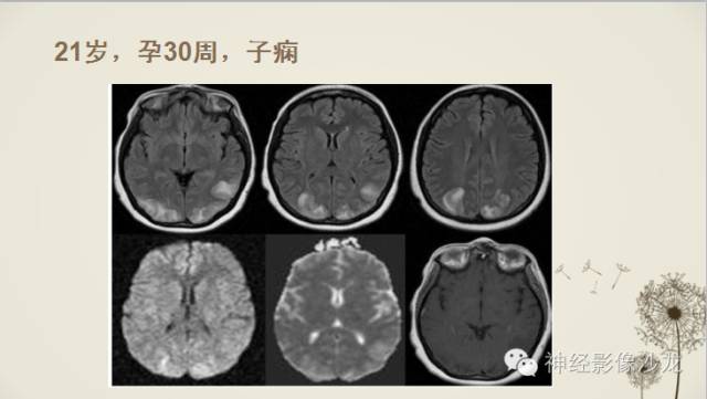 【病例】渗透性脱髓鞘综合征1例MR影像表现与鉴别