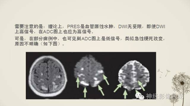 【病例】渗透性脱髓鞘综合征1例MR影像表现与鉴别
