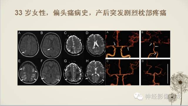 【病例】渗透性脱髓鞘综合征1例MR影像表现与鉴别