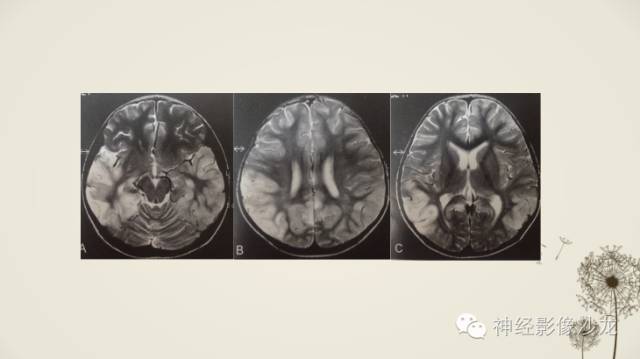 【病例】渗透性脱髓鞘综合征1例MR影像表现与鉴别