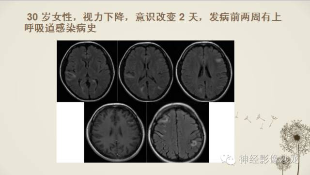 【病例】渗透性脱髓鞘综合征1例MR影像表现与鉴别