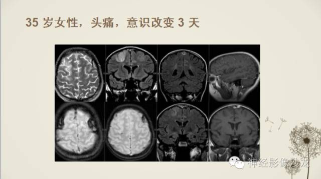 【病例】渗透性脱髓鞘综合征1例MR影像表现与鉴别