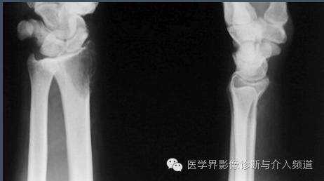 【病例】桡骨骨巨细胞瘤1例X线影像表现