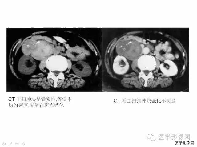 【病例】腹膜后静脉性海绵状血管瘤1例CT影像表现