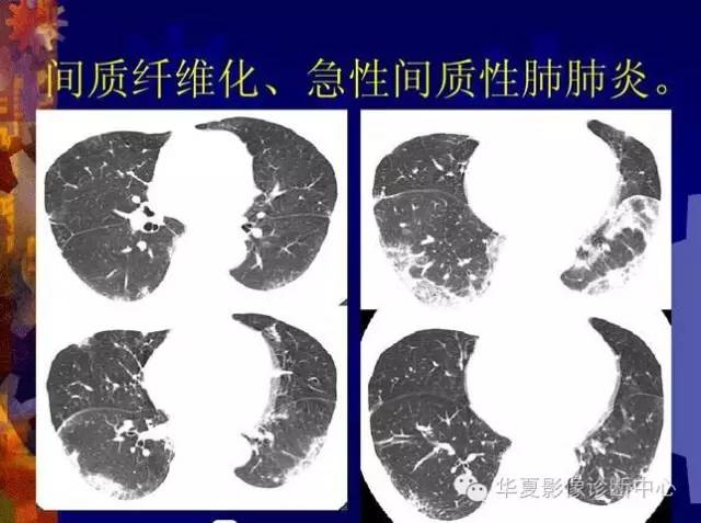 大叶性、小叶性、间质性肺炎你分清了吗？