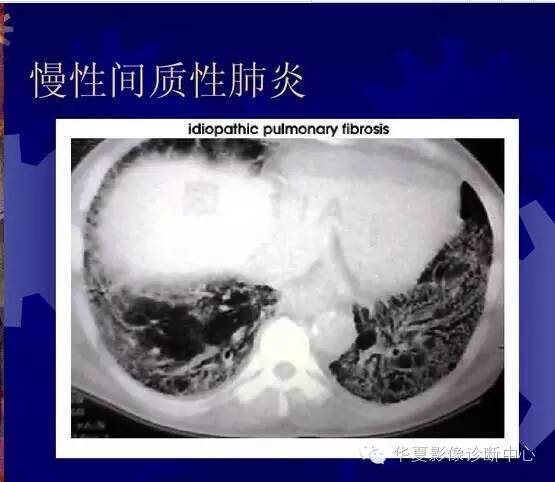 大叶性、小叶性、间质性肺炎你分清了吗？