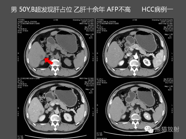 【PPT】肝脏影像学培训内容