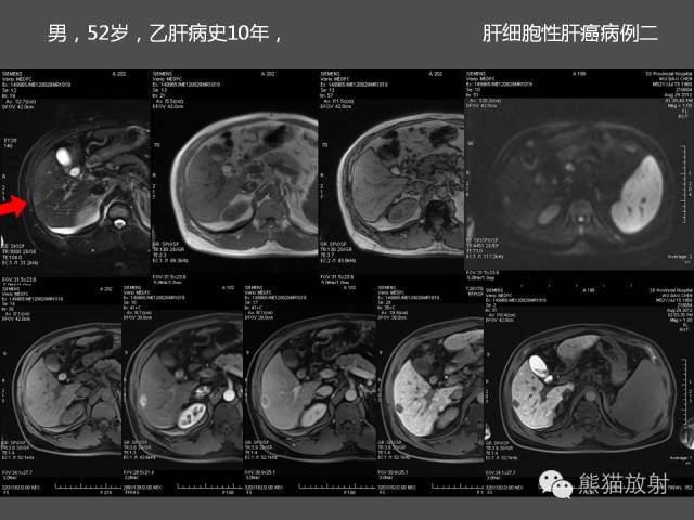 【PPT】肝脏影像学培训内容