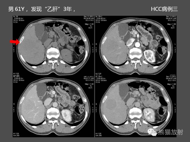 【PPT】肝脏影像学培训内容