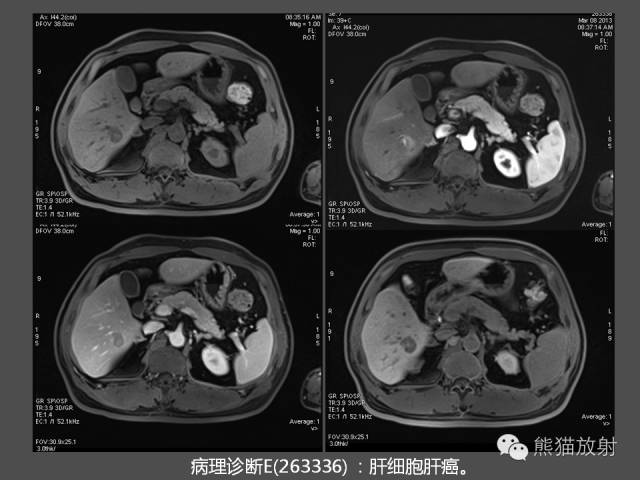 【PPT】肝脏影像学培训内容