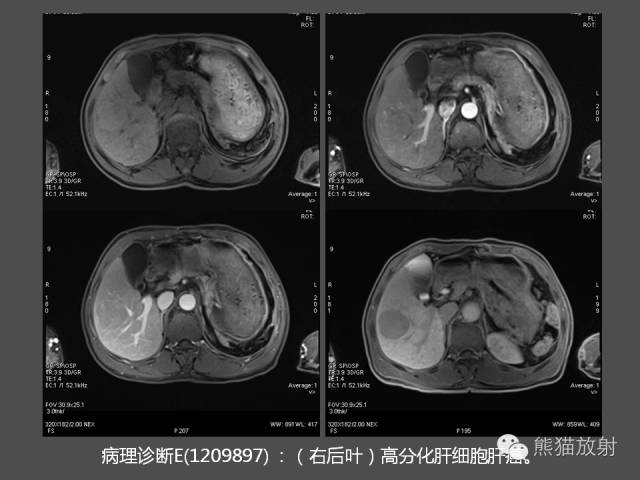 【PPT】肝脏影像学培训内容