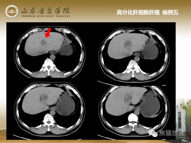【PPT】肝脏影像学培训内容