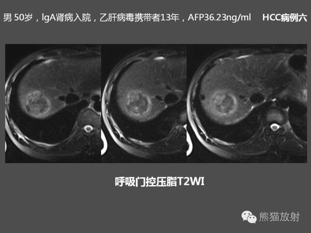 【PPT】肝脏影像学培训内容