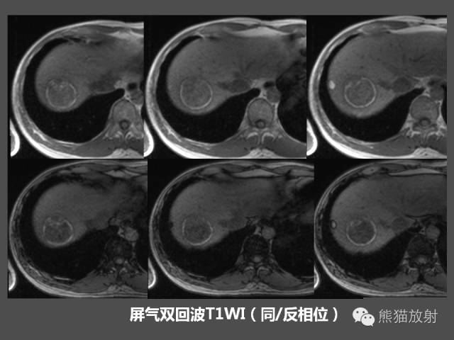 【PPT】肝脏影像学培训内容