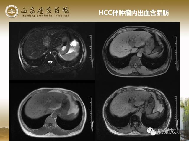 【PPT】肝脏影像学培训内容