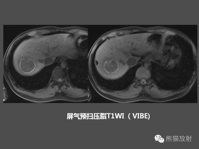 【PPT】肝脏影像学培训内容