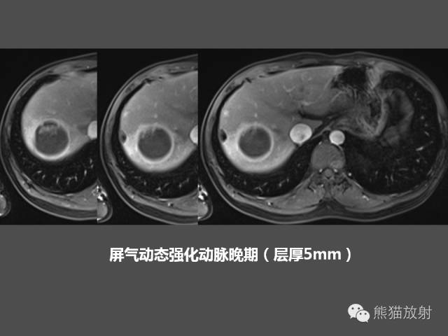 【PPT】肝脏影像学培训内容