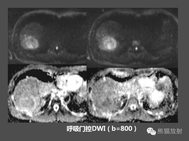 【PPT】肝脏影像学培训内容