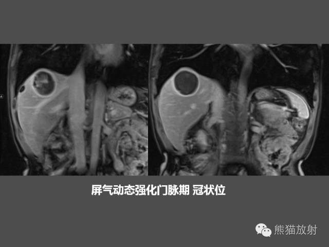 【PPT】肝脏影像学培训内容