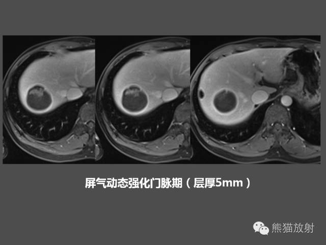 【PPT】肝脏影像学培训内容