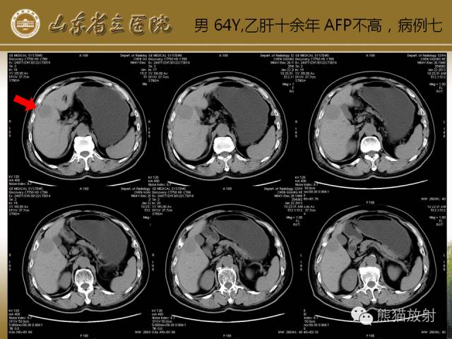 【PPT】肝脏影像学培训内容