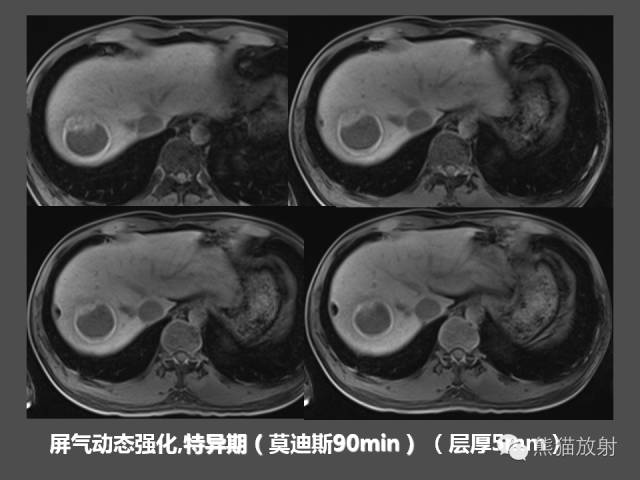 【PPT】肝脏影像学培训内容