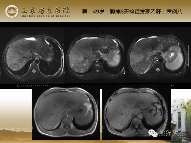 【PPT】肝脏影像学培训内容