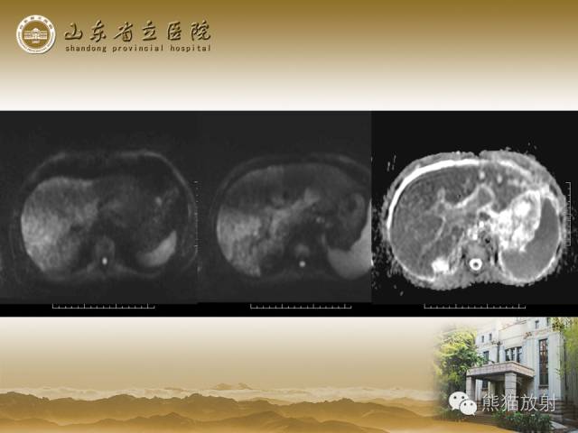 【PPT】肝脏影像学培训内容