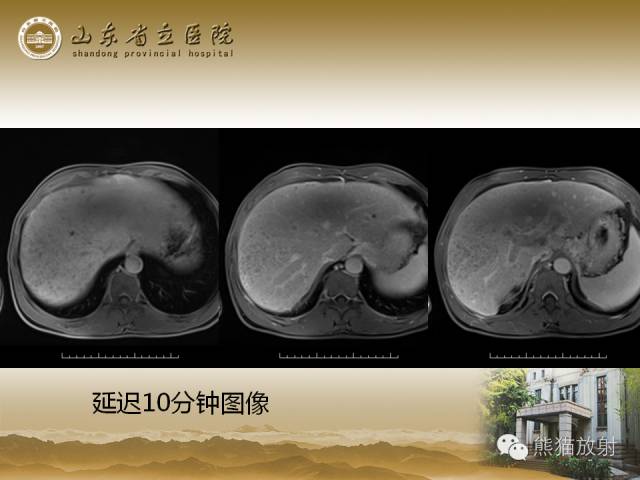 【PPT】肝脏影像学培训内容
