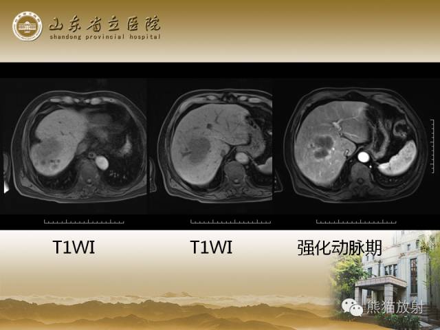 【PPT】肝脏影像学培训内容
