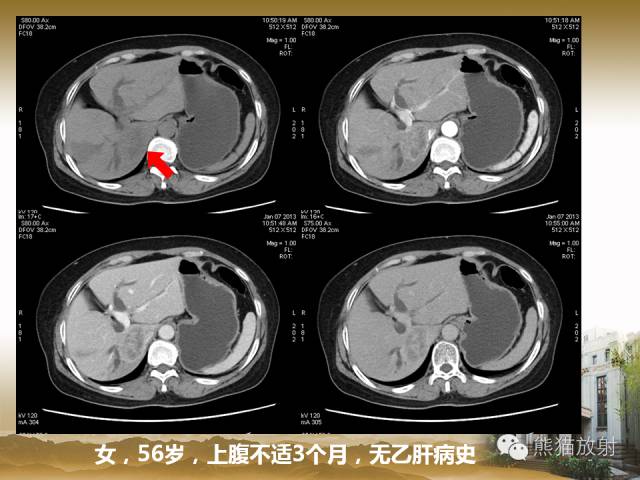 【PPT】肝脏影像学培训内容