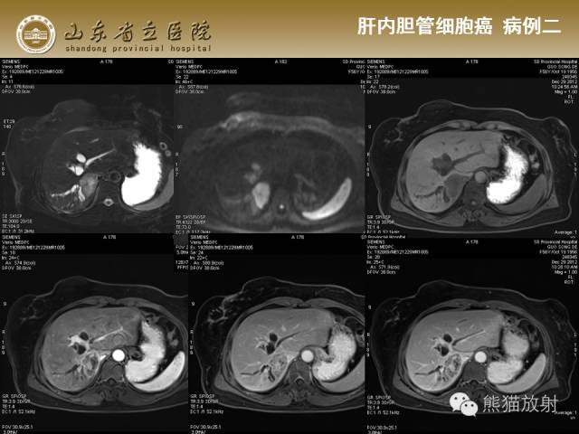 【PPT】肝脏影像学培训内容