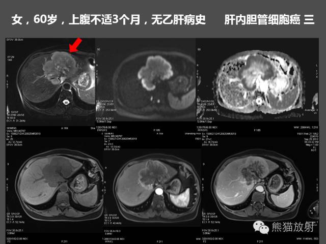 【PPT】肝脏影像学培训内容