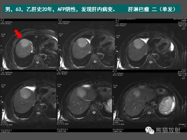 【PPT】肝脏影像学培训内容