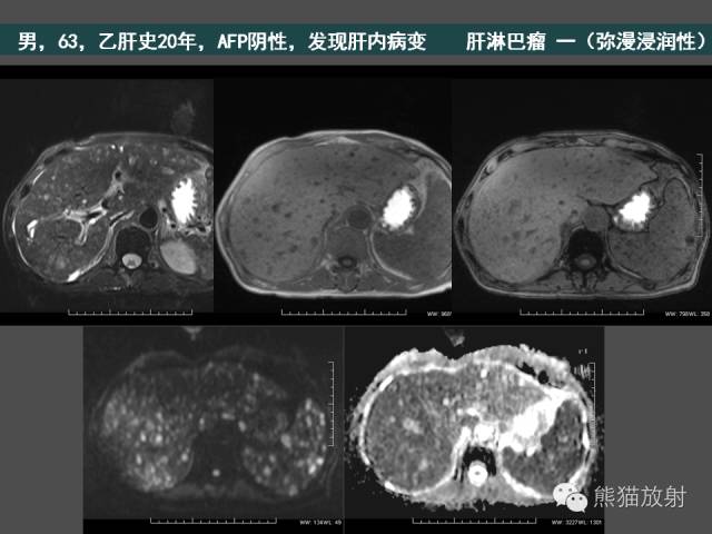 【PPT】肝脏影像学培训内容