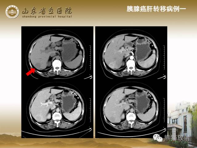 【PPT】肝脏影像学培训内容