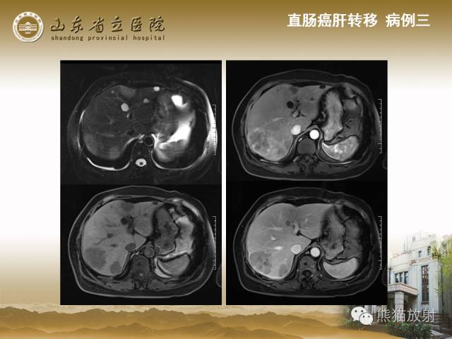 【PPT】肝脏影像学培训内容