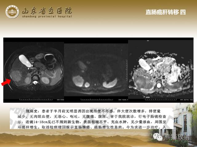 【PPT】肝脏影像学培训内容