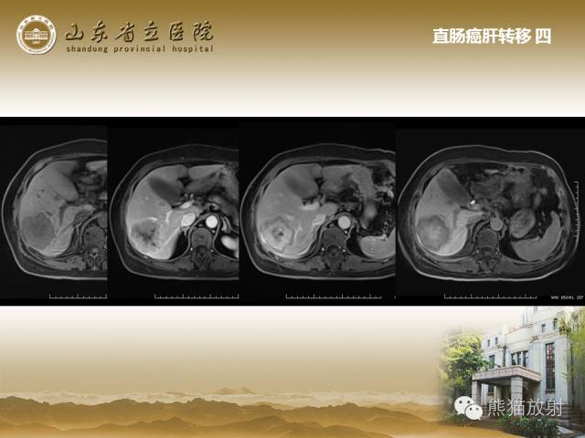 【PPT】肝脏影像学培训内容