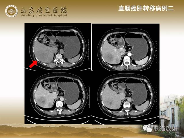 【PPT】肝脏影像学培训内容