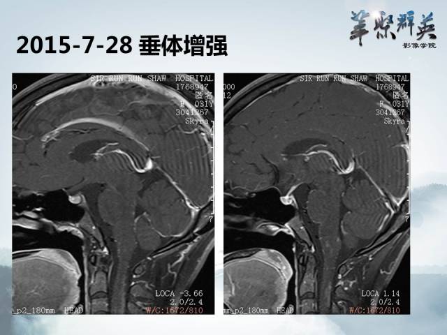 【病例】视神经脊髓炎1例MR影像表现