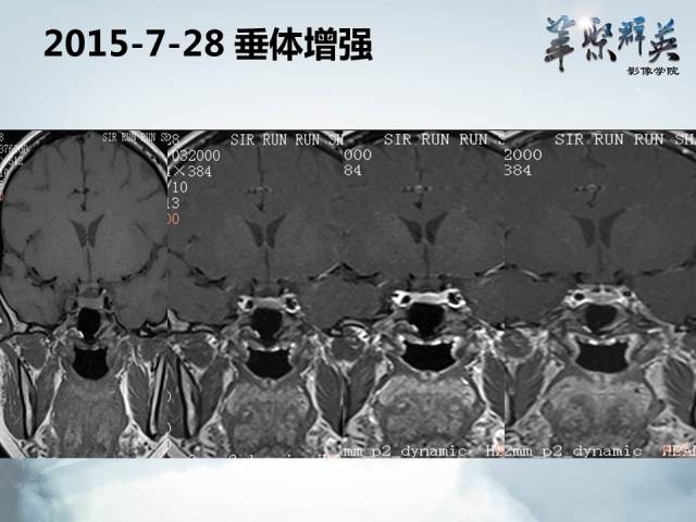 【病例】视神经脊髓炎1例MR影像表现