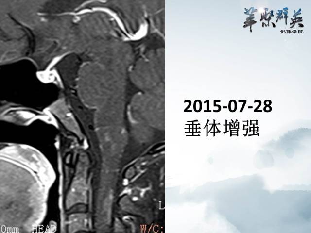 【病例】视神经脊髓炎1例MR影像表现