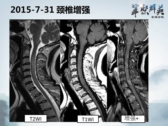 【病例】视神经脊髓炎1例MR影像表现