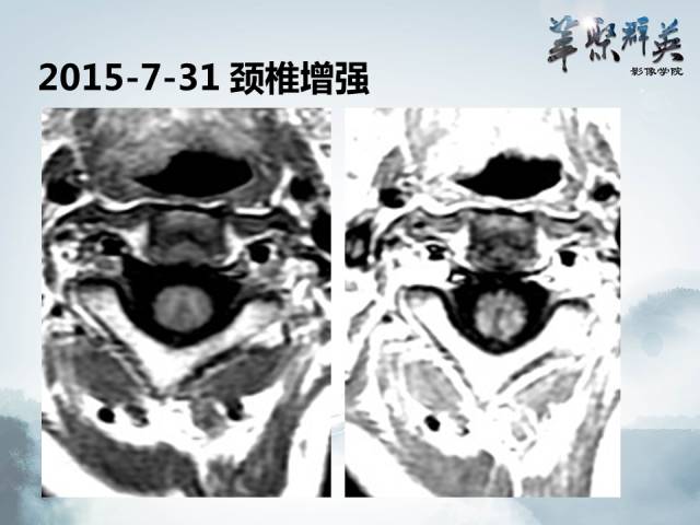 【病例】视神经脊髓炎1例MR影像表现