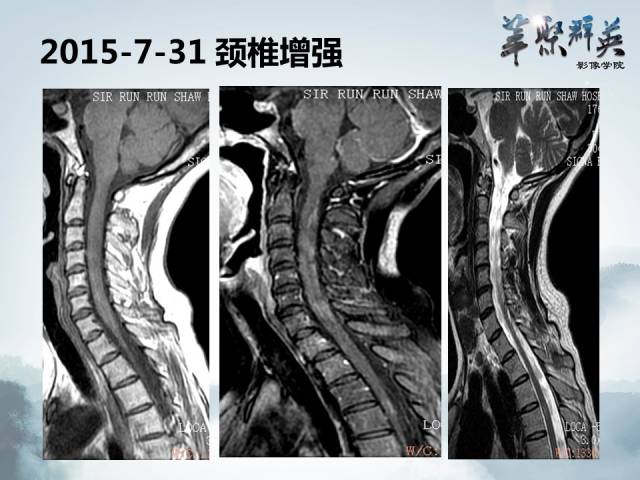 【病例】视神经脊髓炎1例MR影像表现