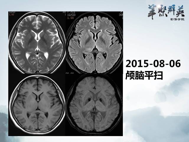 【病例】视神经脊髓炎1例MR影像表现