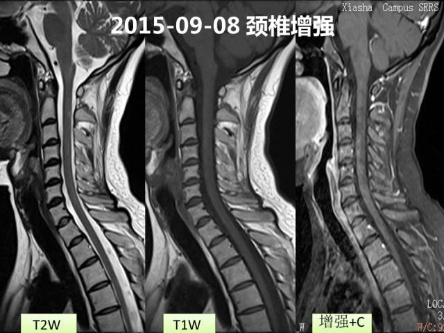 【病例】视神经脊髓炎1例MR影像表现