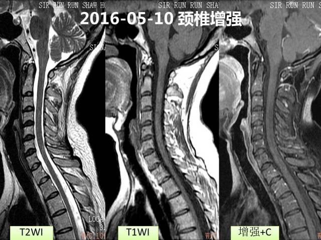 【病例】视神经脊髓炎1例MR影像表现